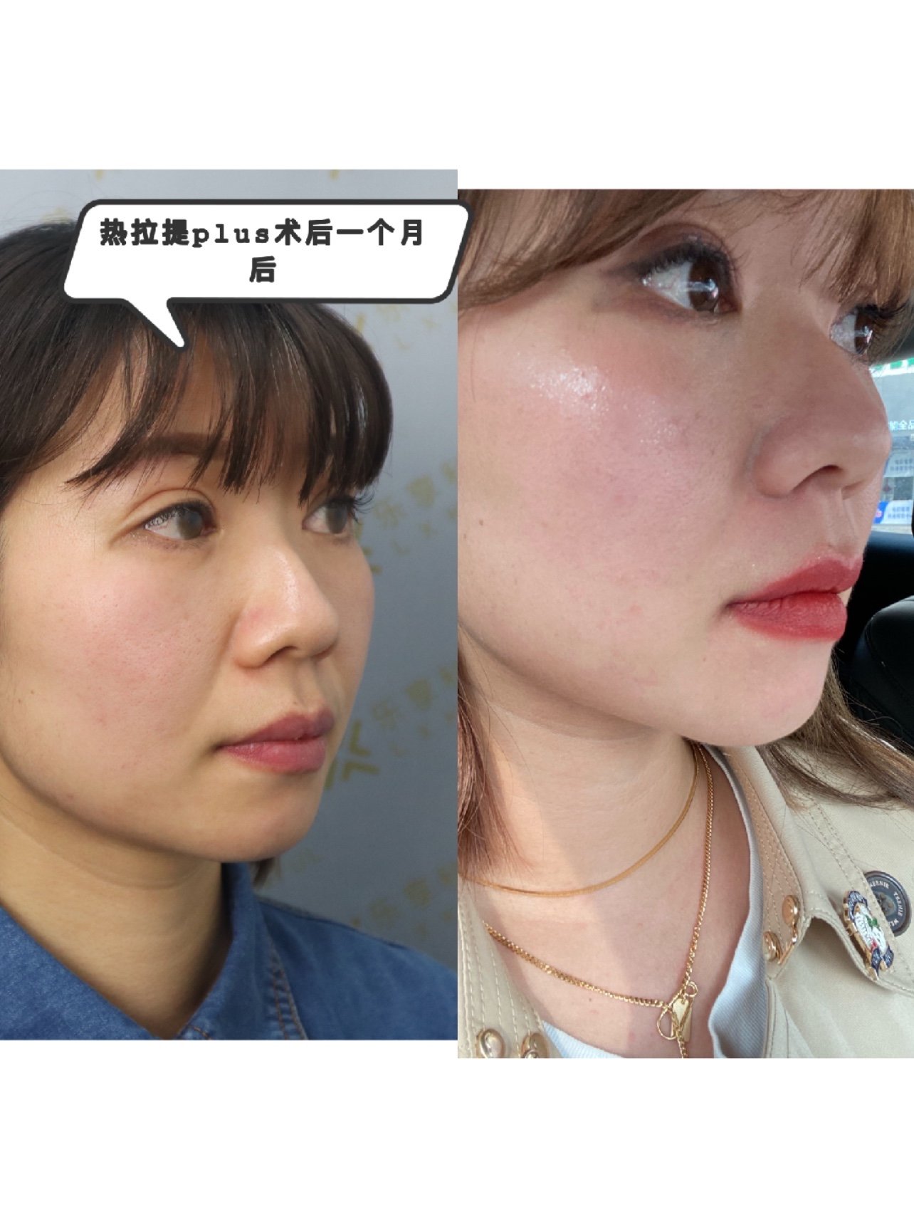 热拉提plus术后一个月原相机对比图来啦!过完年长_圈子-新氧美容整形