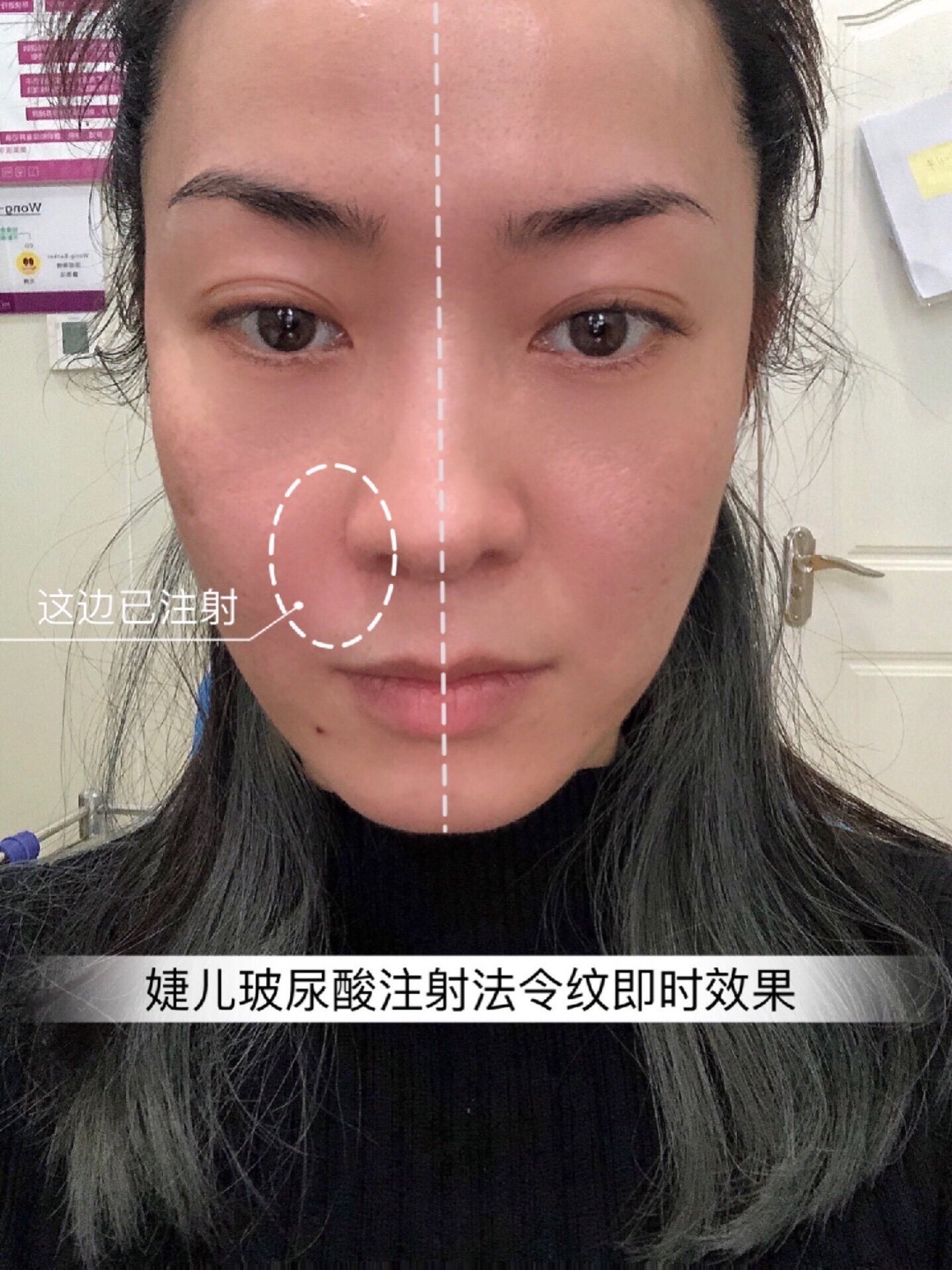 =婕尔玻尿酸注射法令纹恢复第天=
