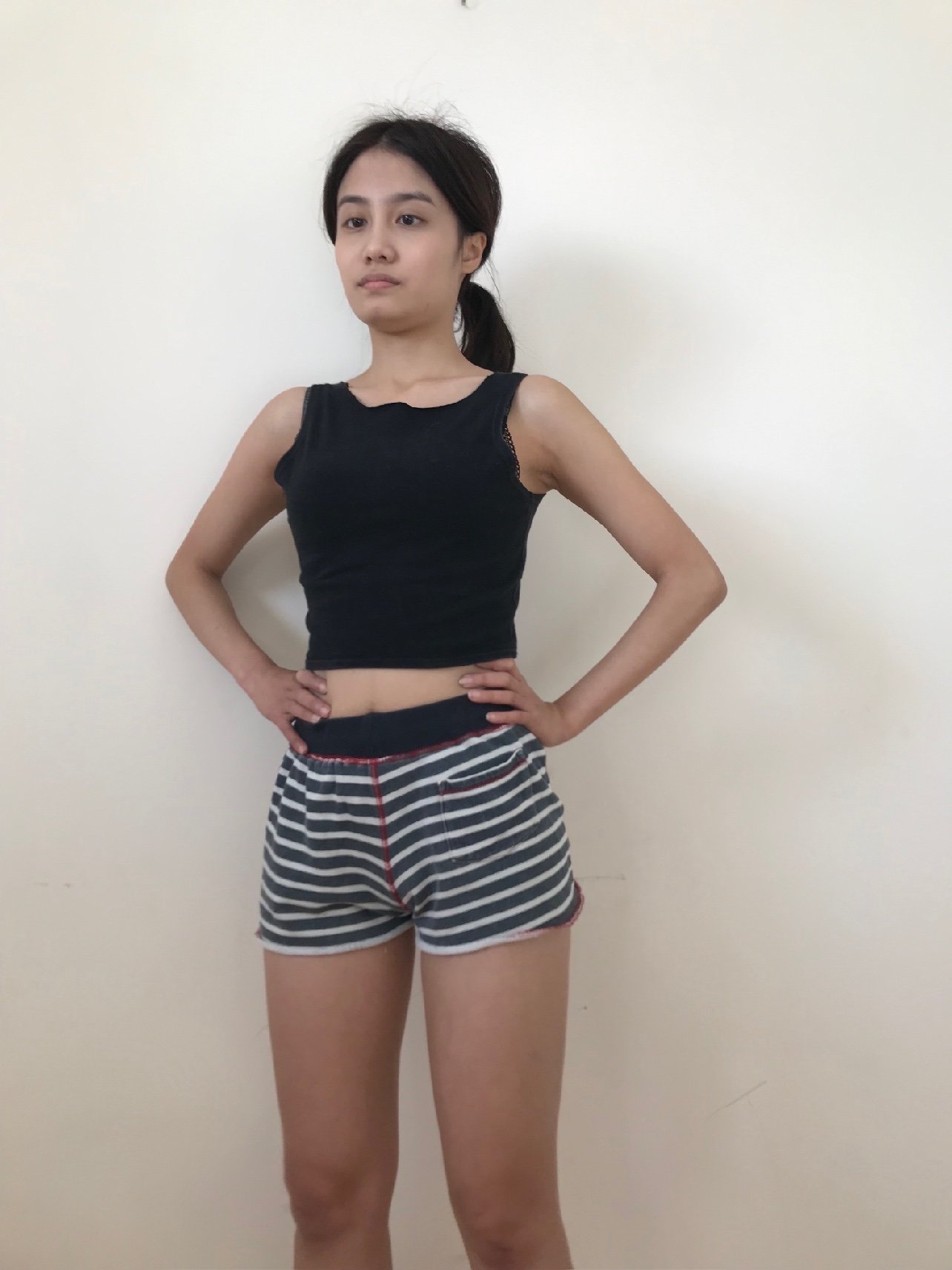 大腿吸脂 黄金微雕