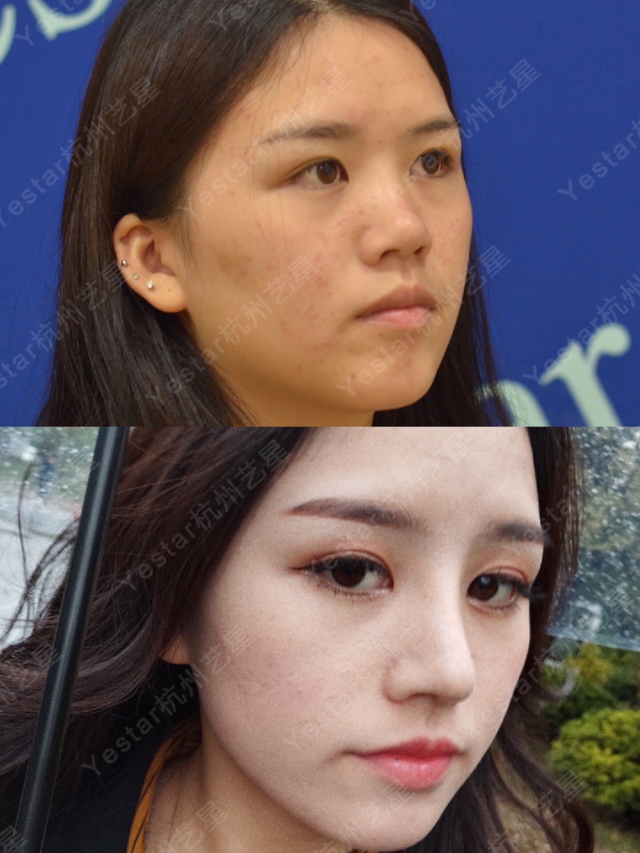 术前塌鼻梁正面侧面看着都没有鼻梁