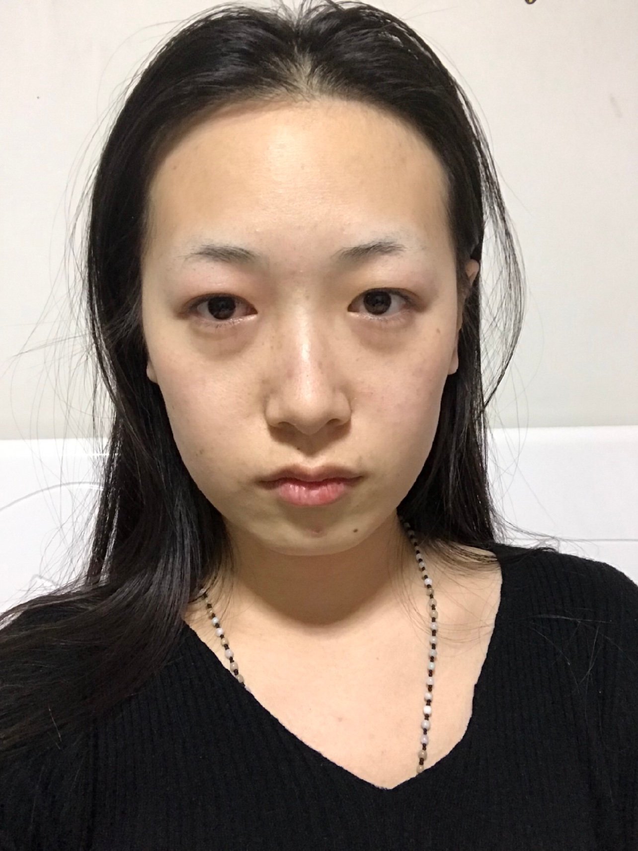 1从面部来说,患者总体五官较好,泪沟黑眼圈明显,从而导致显老.
