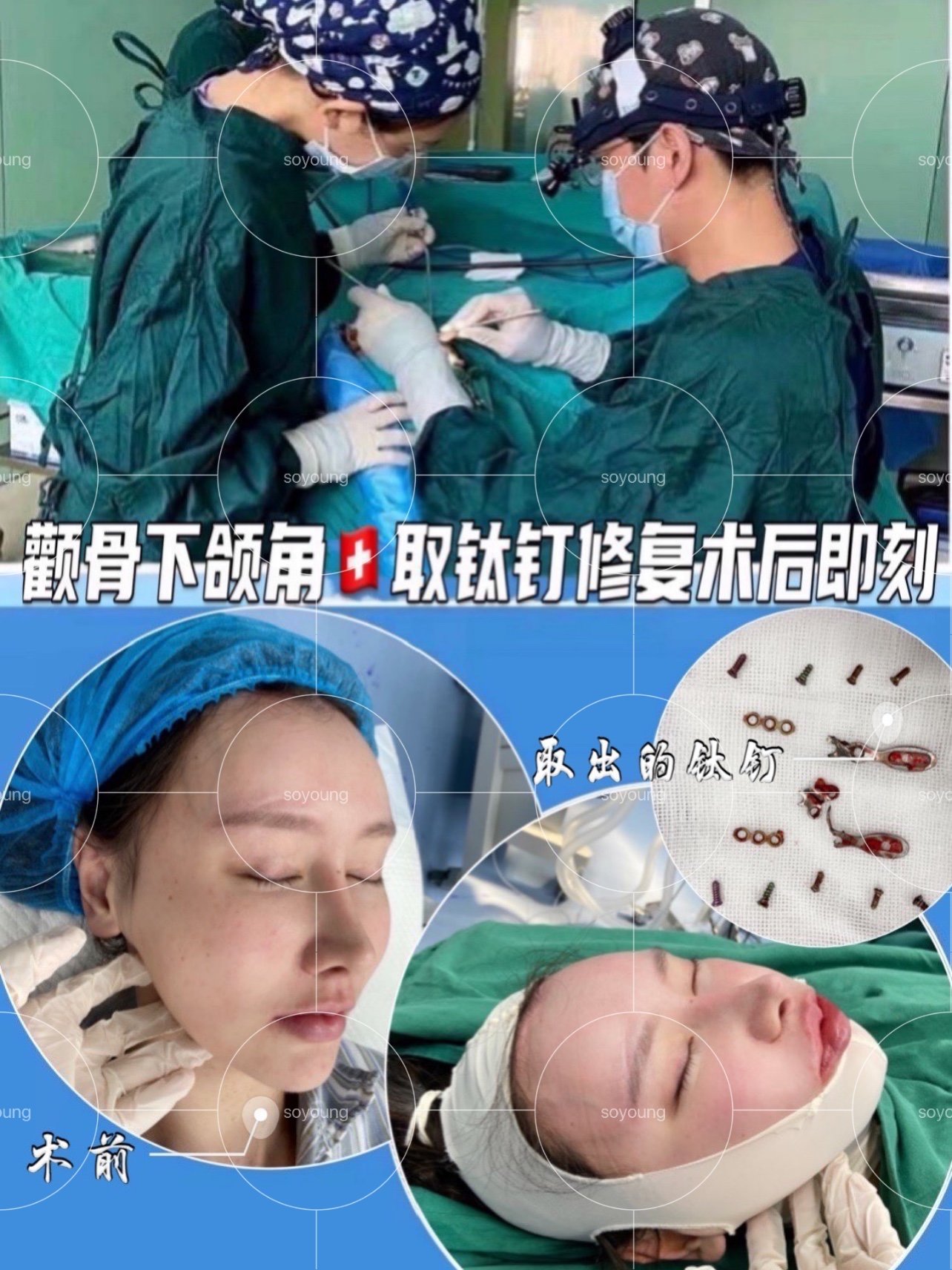 颧骨下颌角修复,钛钉取出!