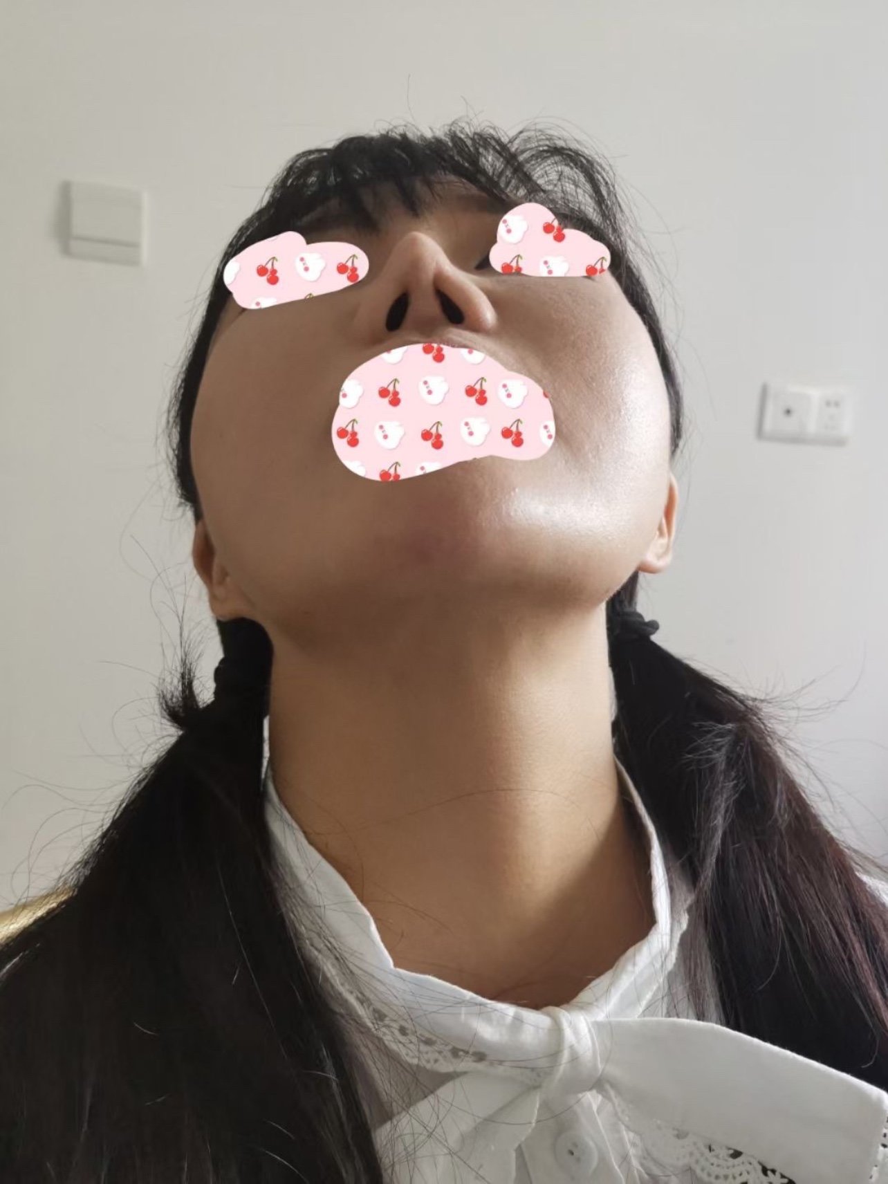 06我的是肋骨鼻挛缩严重,鼻头两个角,一直想修复,问_圈子-新氧美容