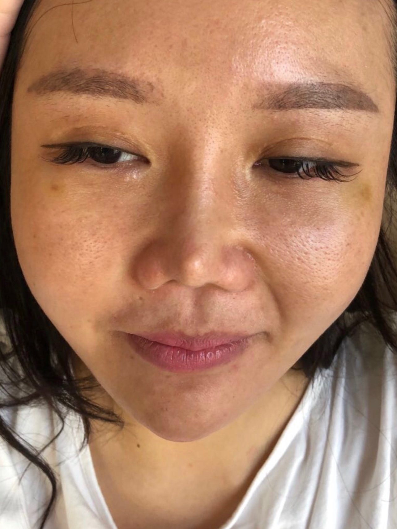 06我的是肋骨鼻挛缩严重,鼻头两个角,一直想修复,问_圈子-新氧美容