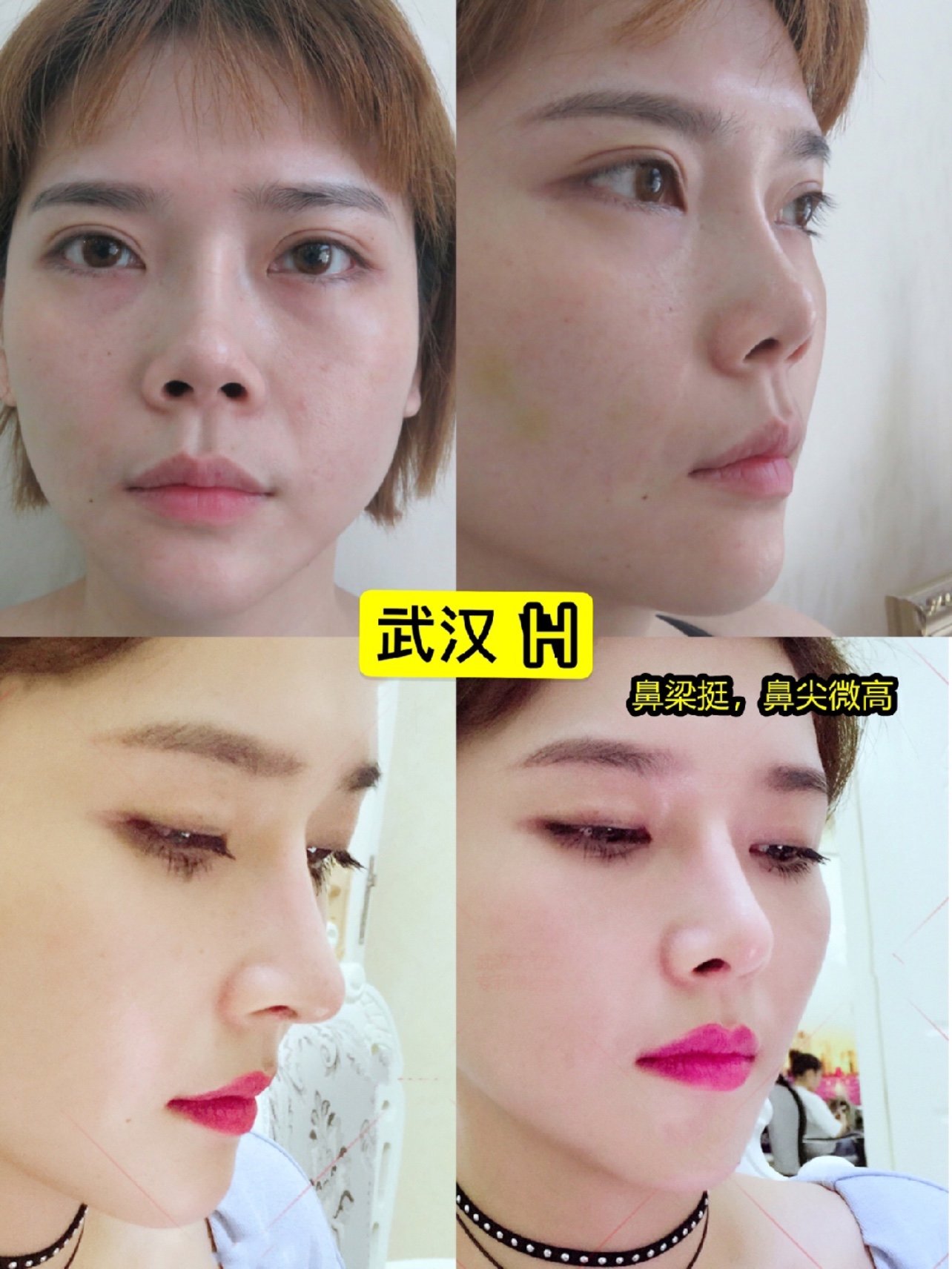 长沙武汉 妈生鼻大佬案例模板 长沙武汉的do鼻子 圈子 新氧美容整形
