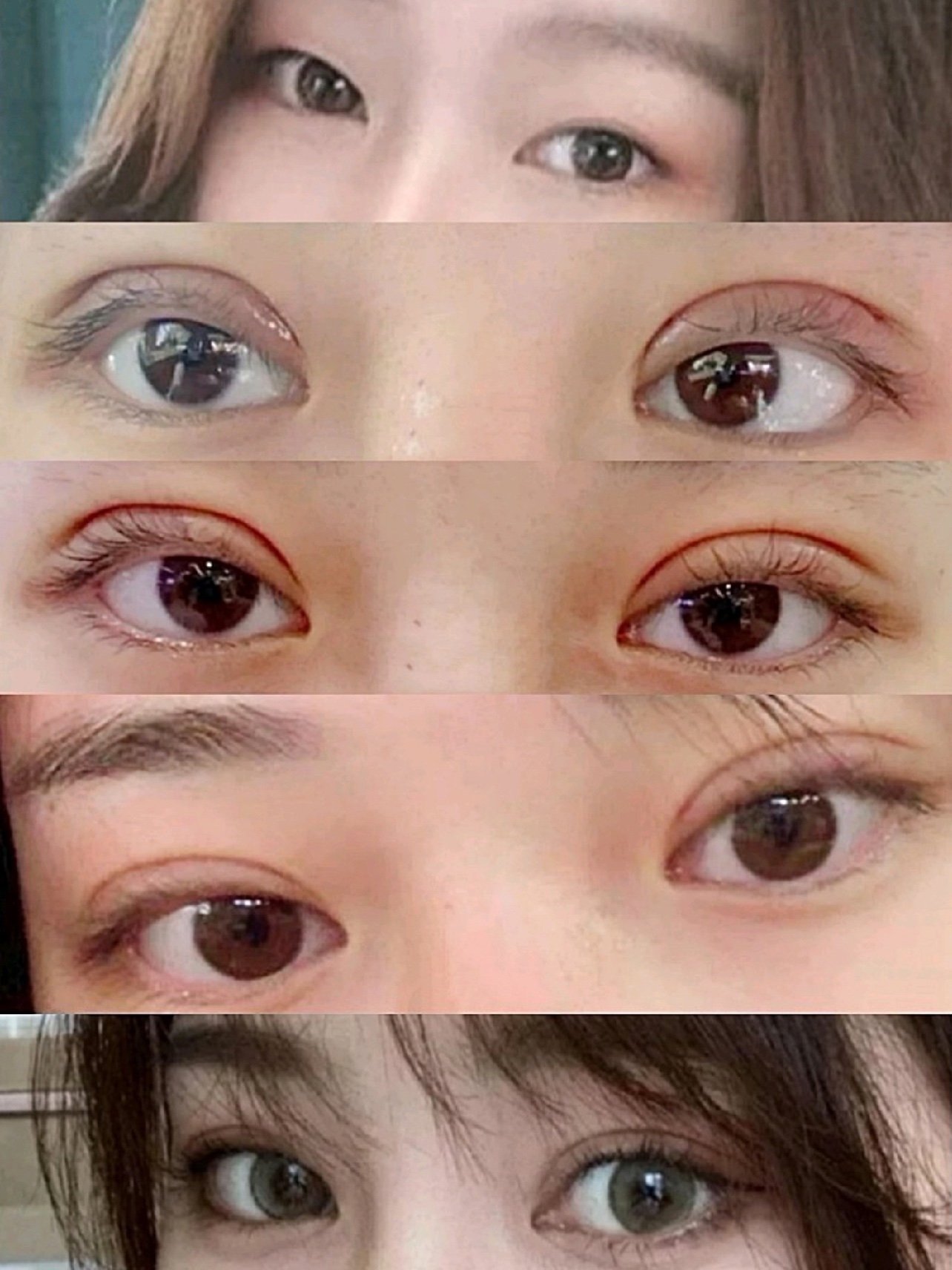 双眼皮的案例分享