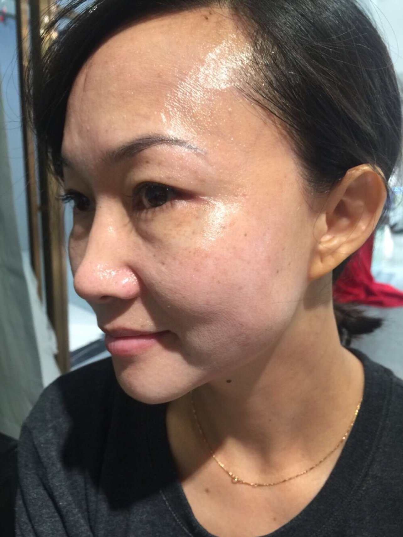 脸上本来松松垮垮的,现在精致了很多,皮肤更有弹性一_圈子-新氧美容