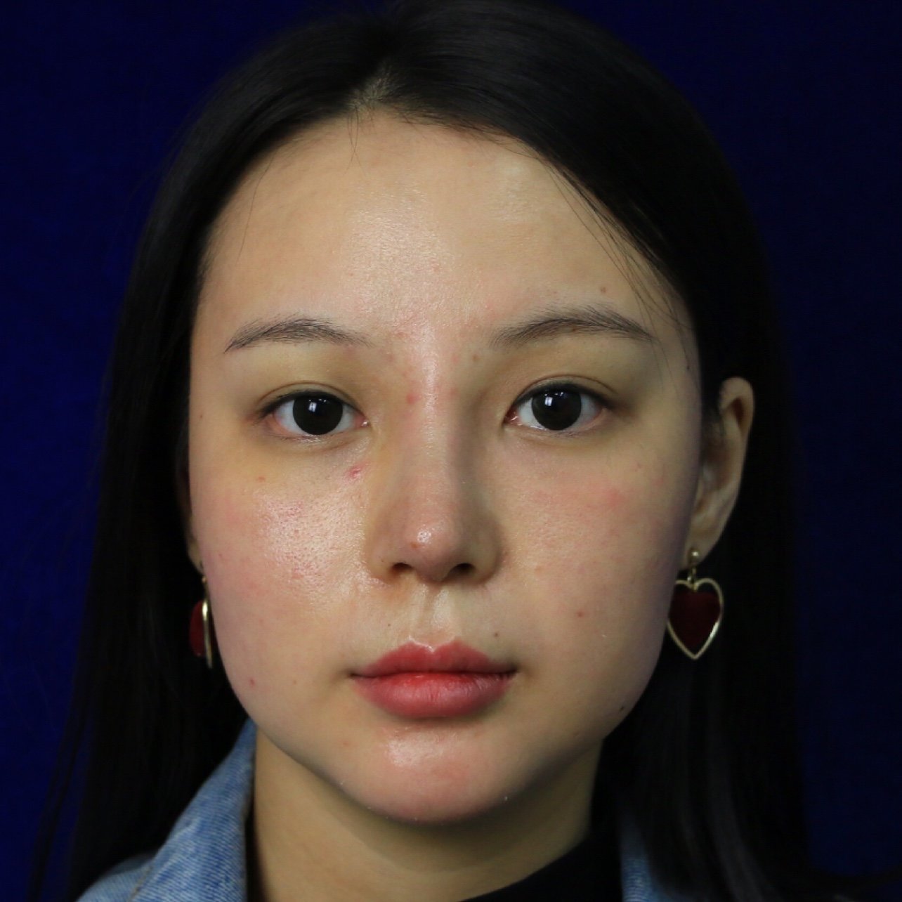 宽鼻矫正案例分享