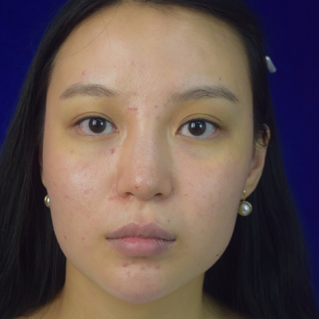 宽鼻矫正案例分享