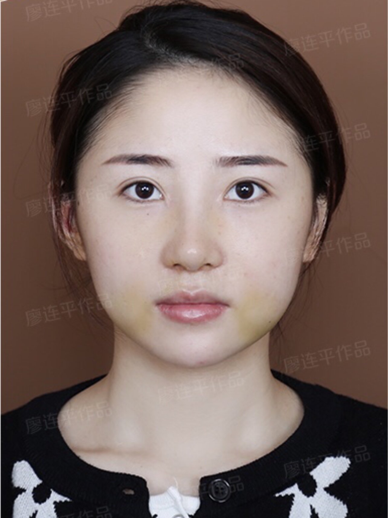 超自然耳软骨自然款:术前鼻子的长度还是可以的,就是_圈子-新氧美容