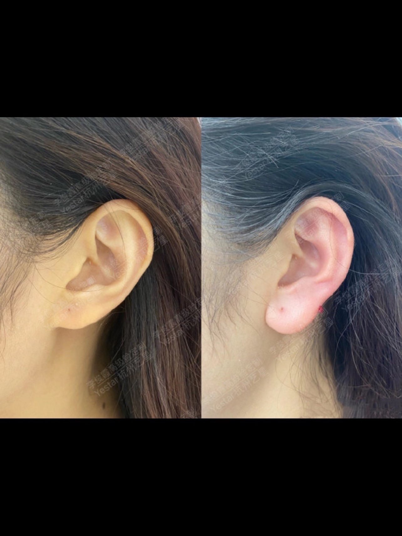 【精灵耳注射案例】耳垂小,内外两条轮廓线不平行
