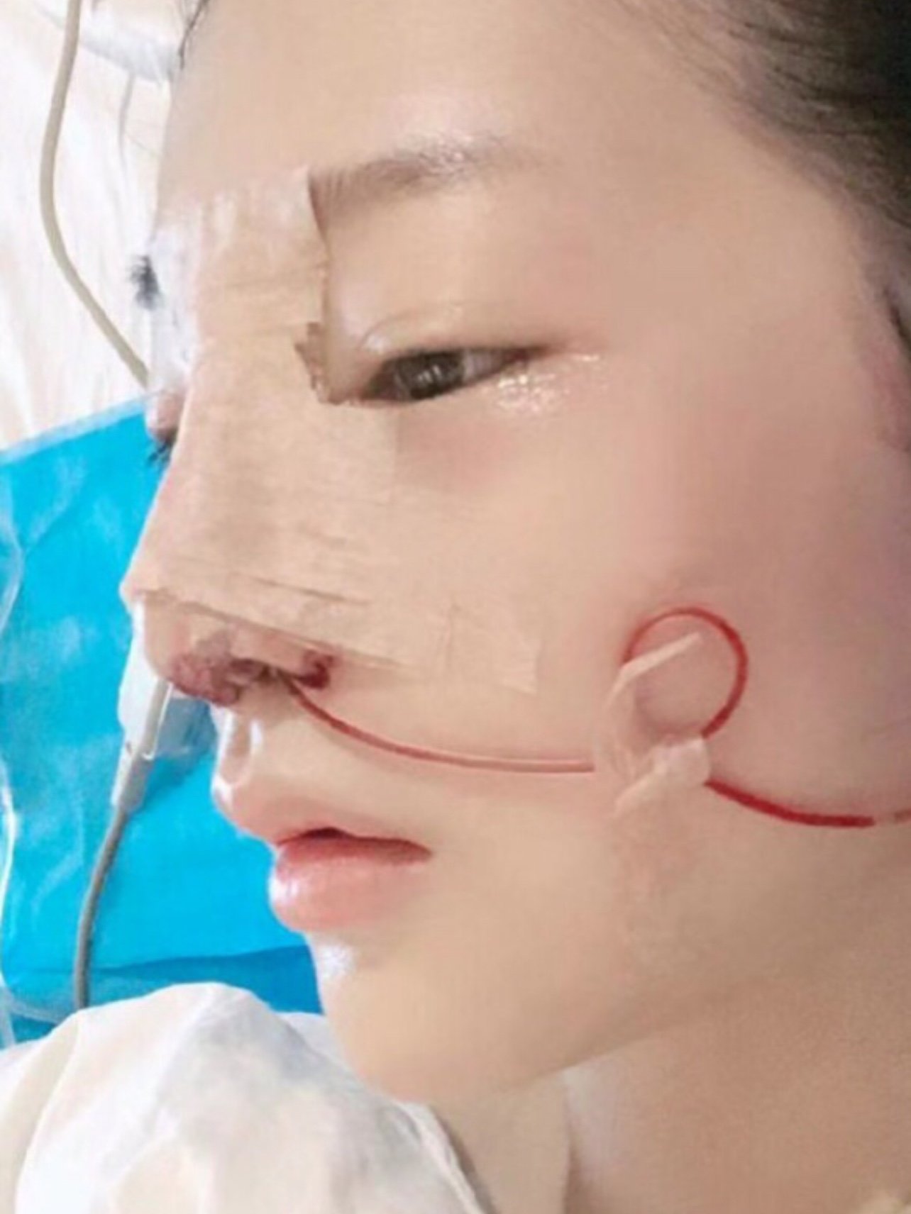 【鼻部多项】三级资质 4项鼻专利 假体 耳软骨隆鼻可揉可捏/缩鼻头