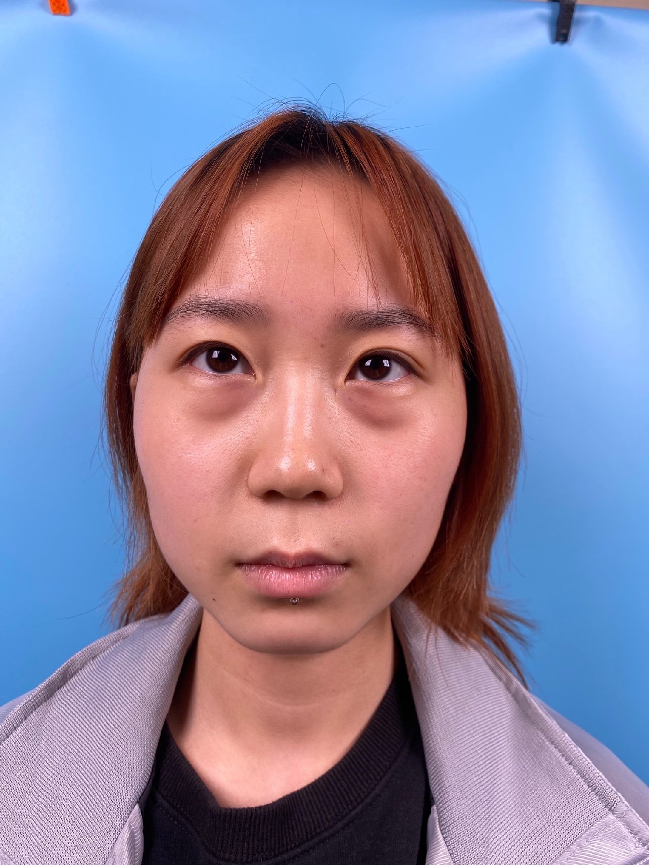 【外切去眼袋】微创精细 外切内切祛眼袋 内路法祛眼袋 微创恢复快