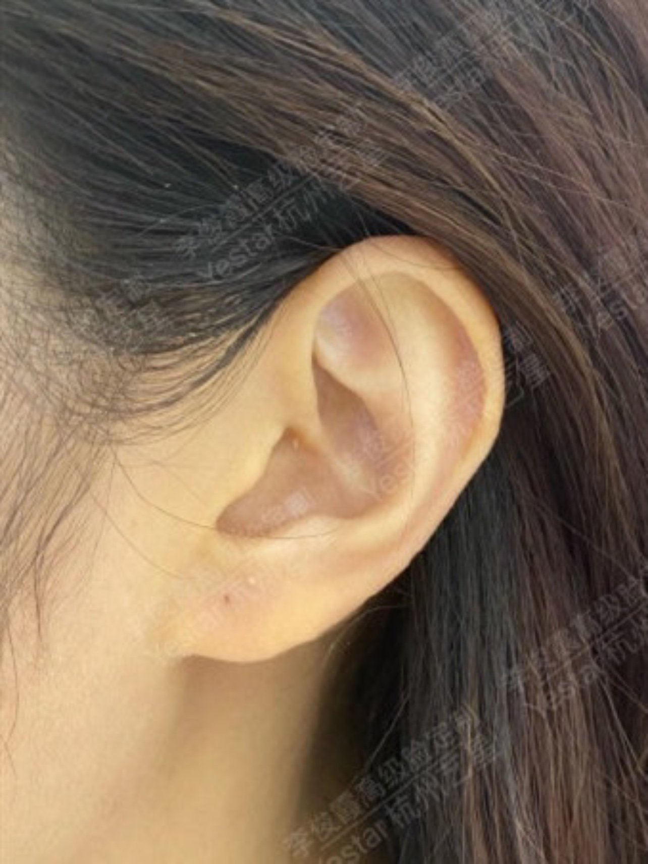 玻尿酸注射精灵耳              现如今,求美者的爱美意识已经