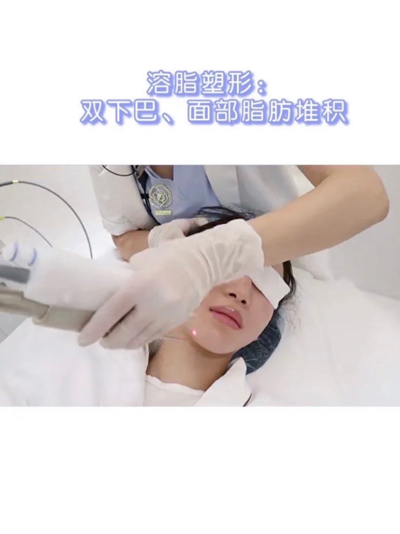 fotona4d无创激光面雕787878fotona4d_圈子-新氧美容整形