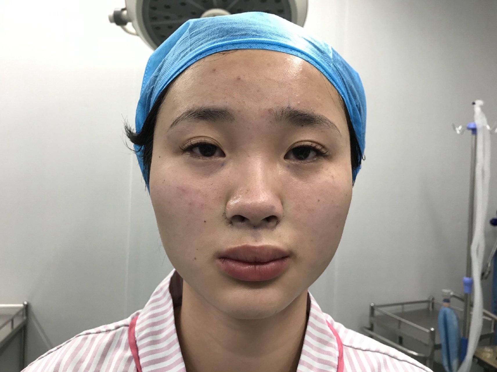 手术缩鼻翼手术缩鼻翼手术缩鼻翼鼻翼缩小