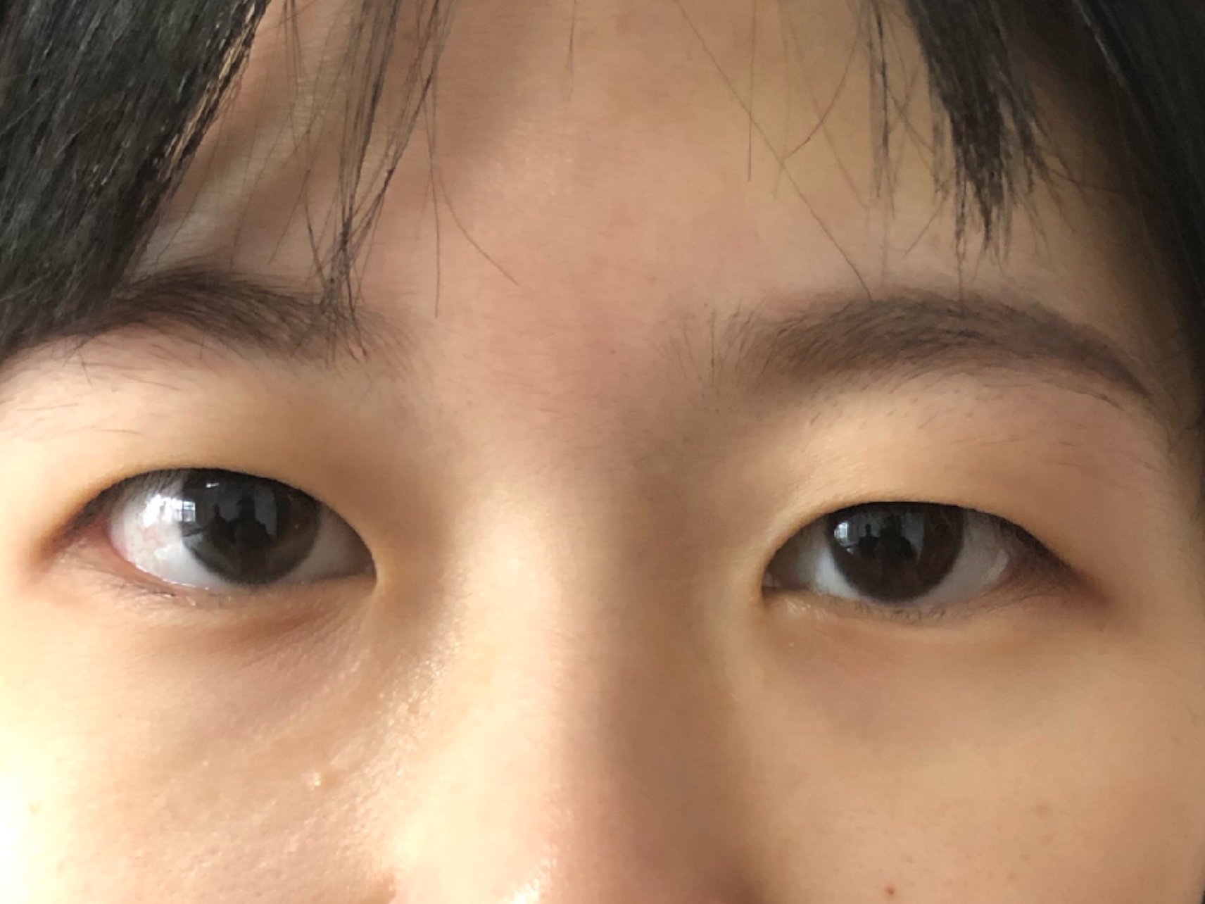 解决大小眼,术后双眼皮自然#上睑下垂矫正患者眼睑肌_圈子-新氧美容