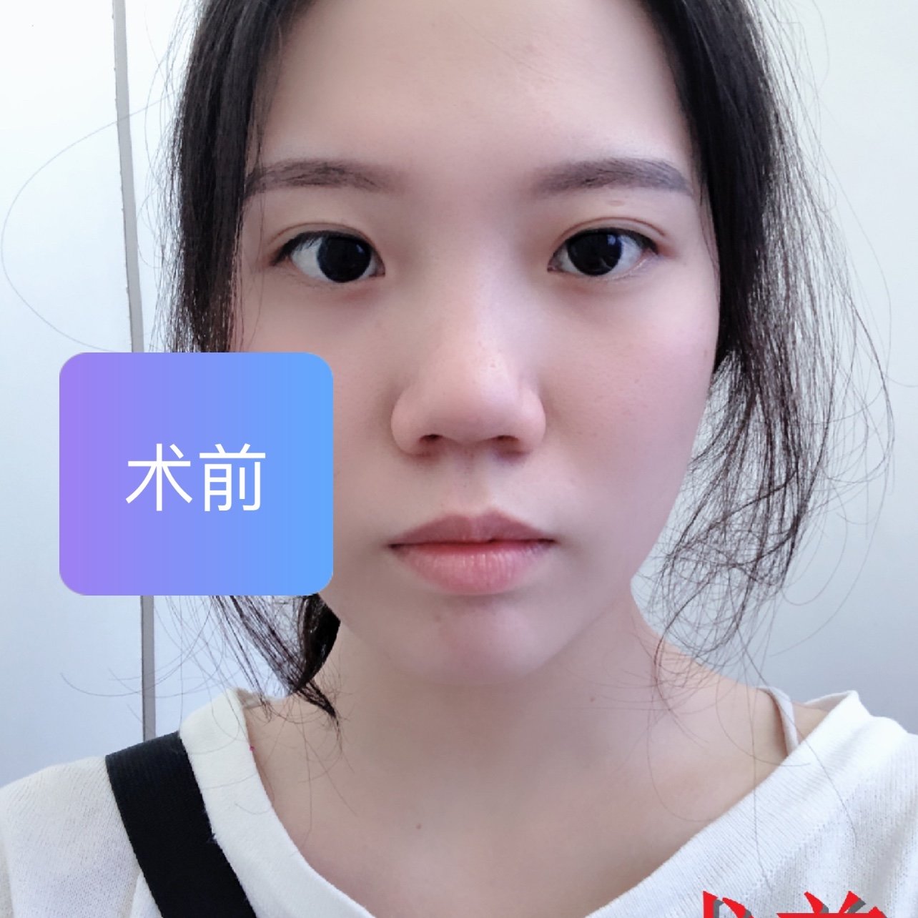 今天给大家分享一个耳软骨隆鼻的变美案例