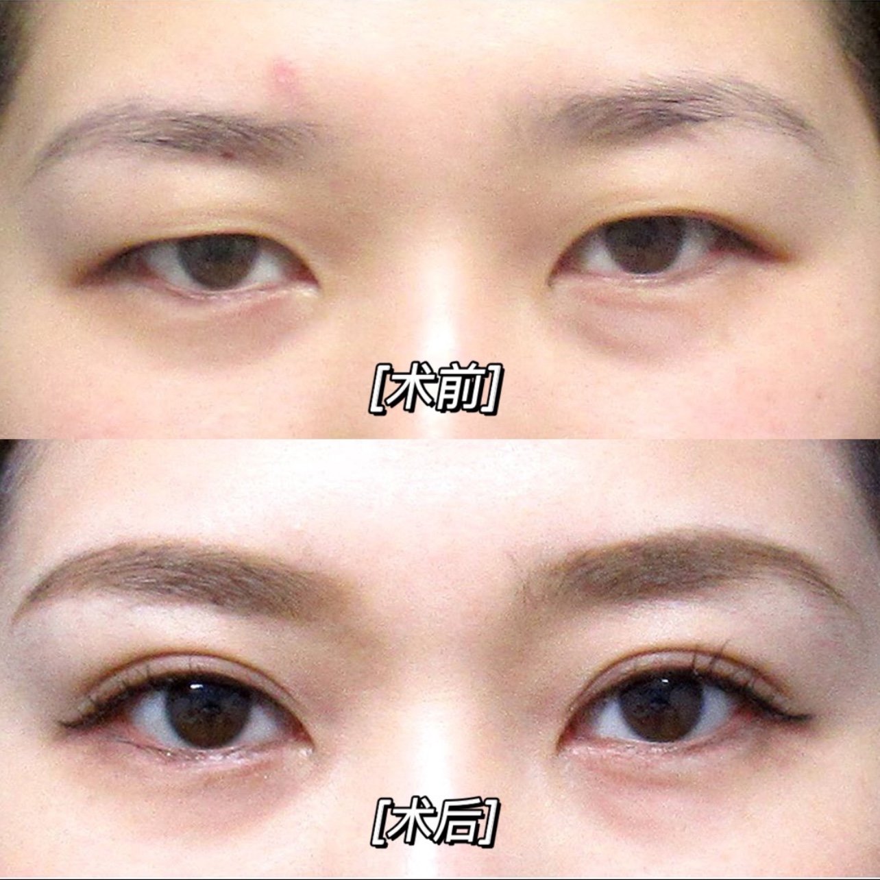 去除适量脂肪和眼轮匝肌,这个妹妹的眼睛不光是脂肪肥厚,肌肉和皮肤