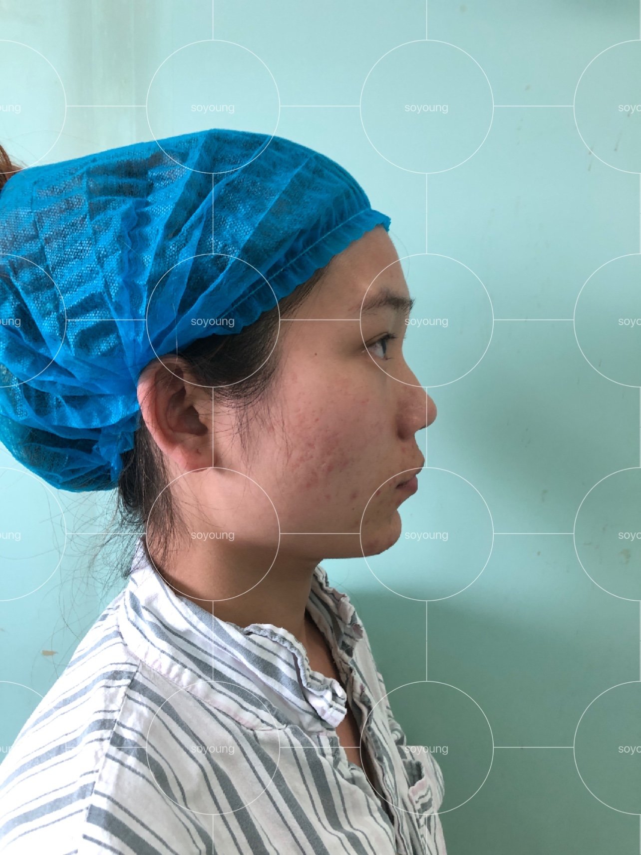 下颌角长曲线术后即刻对比