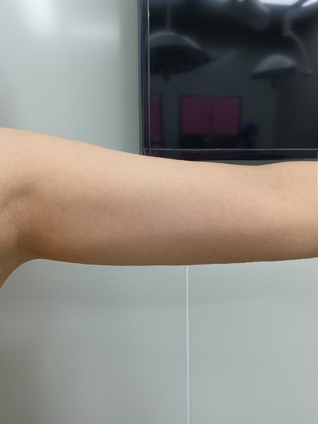 瘦手臂和消除拜拜肉可快速将手臂上的多余的脂肪祛除,_圈子-新氧美容