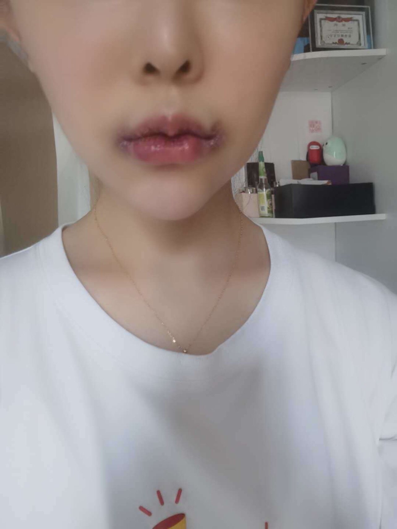 术后3天结痂的样子,m唇形态很明显,唇珠小小的,很_圈子-新氧美容整形