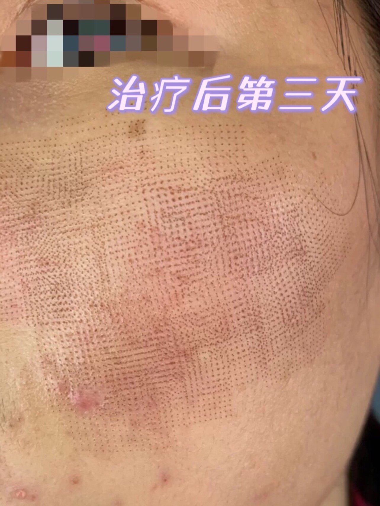 點陣激光去痘坑術後全記錄