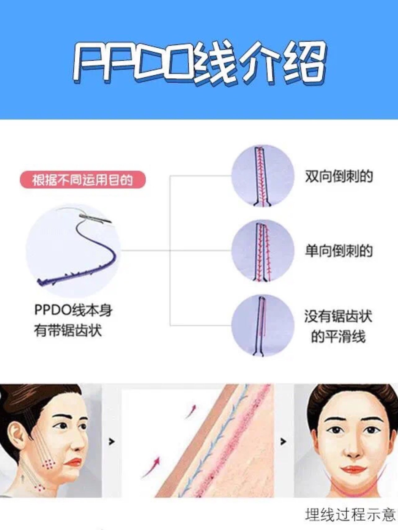 大v线进针点图片