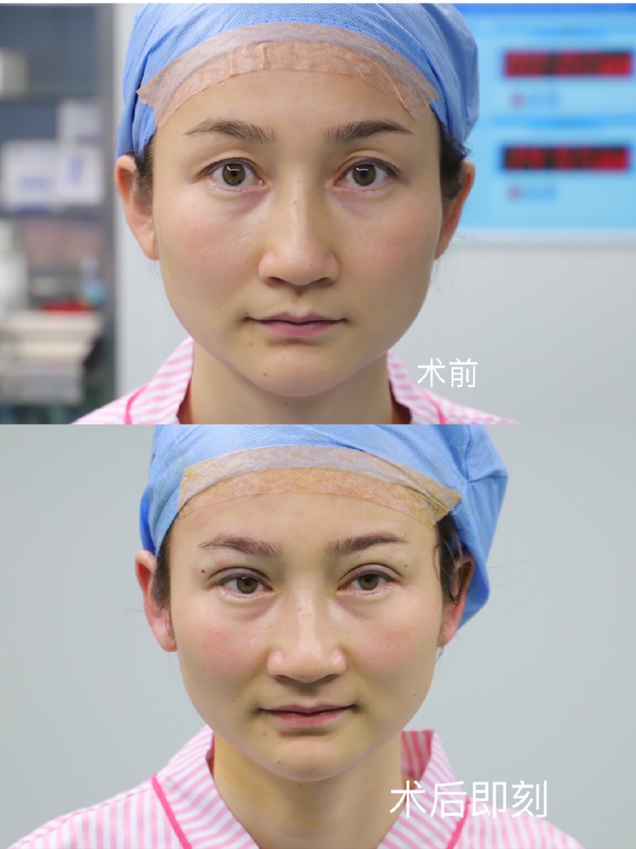 眼部多项手术案例分享～求美者术前多层双眼皮,眼窝凹