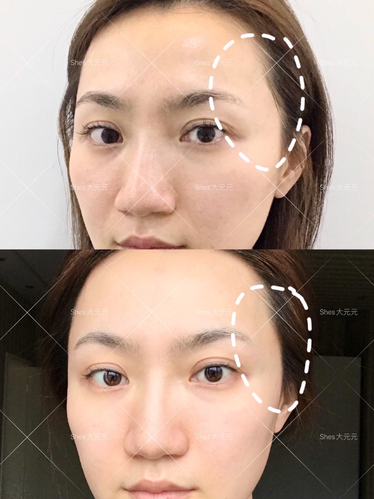 新氧体验官@婕尔今天是注射婕尔玻尿酸填充的第7天_圈子-新氧美容