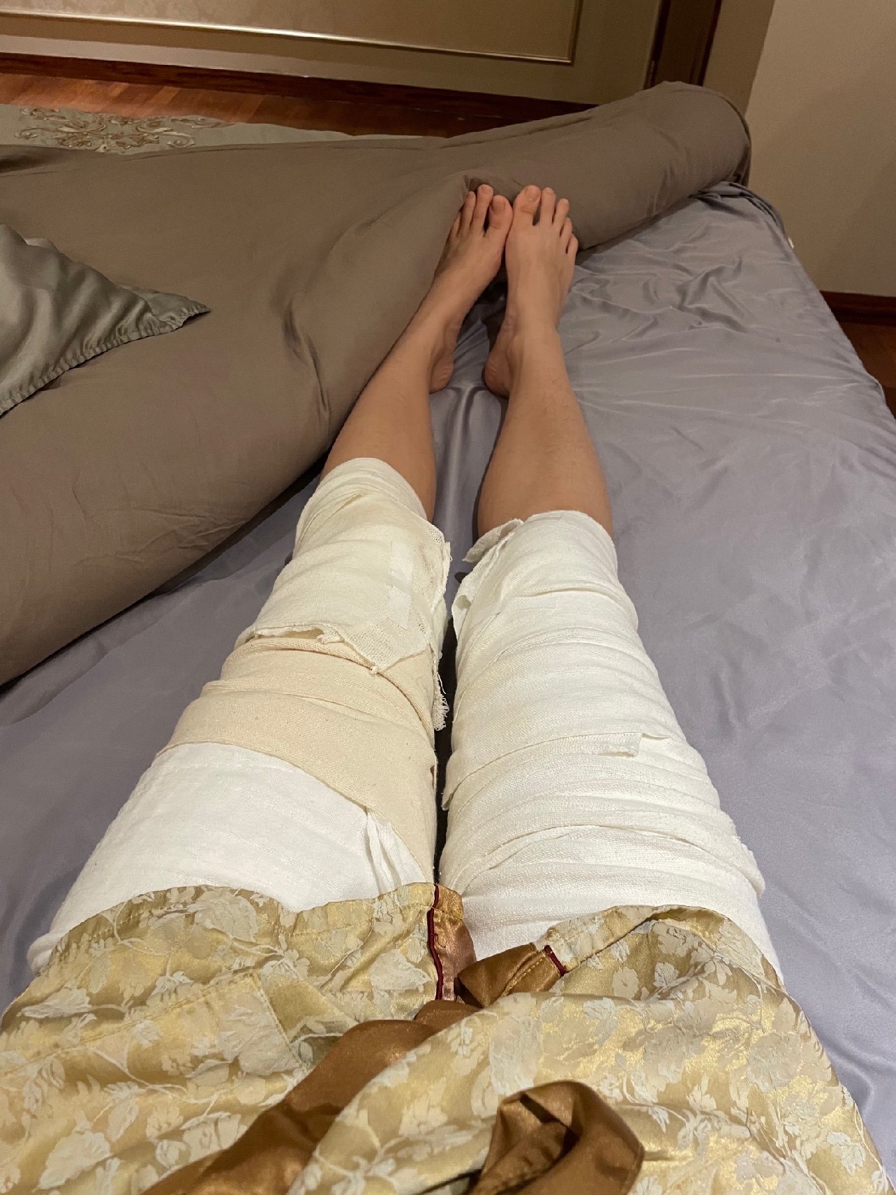 做的项目:大腿吸脂