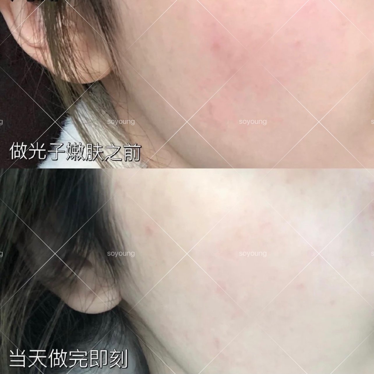 光子嫩肤也太厉害了叭,本来做完即刻和第二天的效果已_圈子-新氧美容