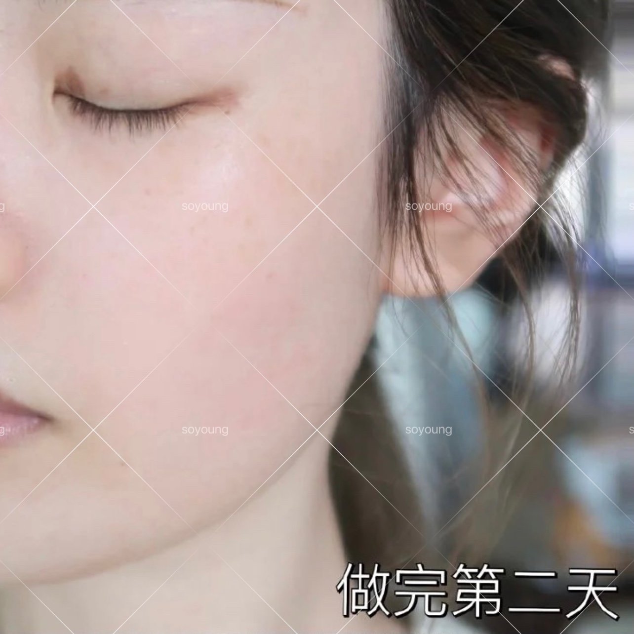 光子嫩肤也太厉害了叭,本来做完即刻和第二天的效果已_圈子-新氧美容