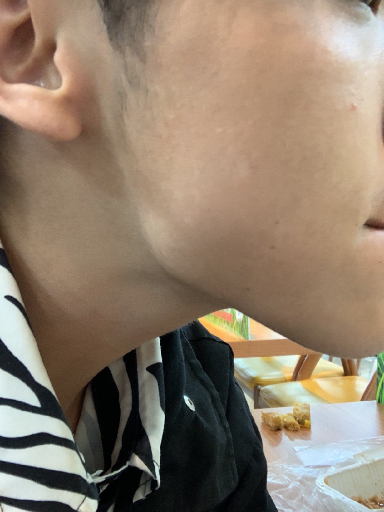 打完针后下颌线明显皮肤不松弛没有任何副作用下次会继_圈子-新氧美容