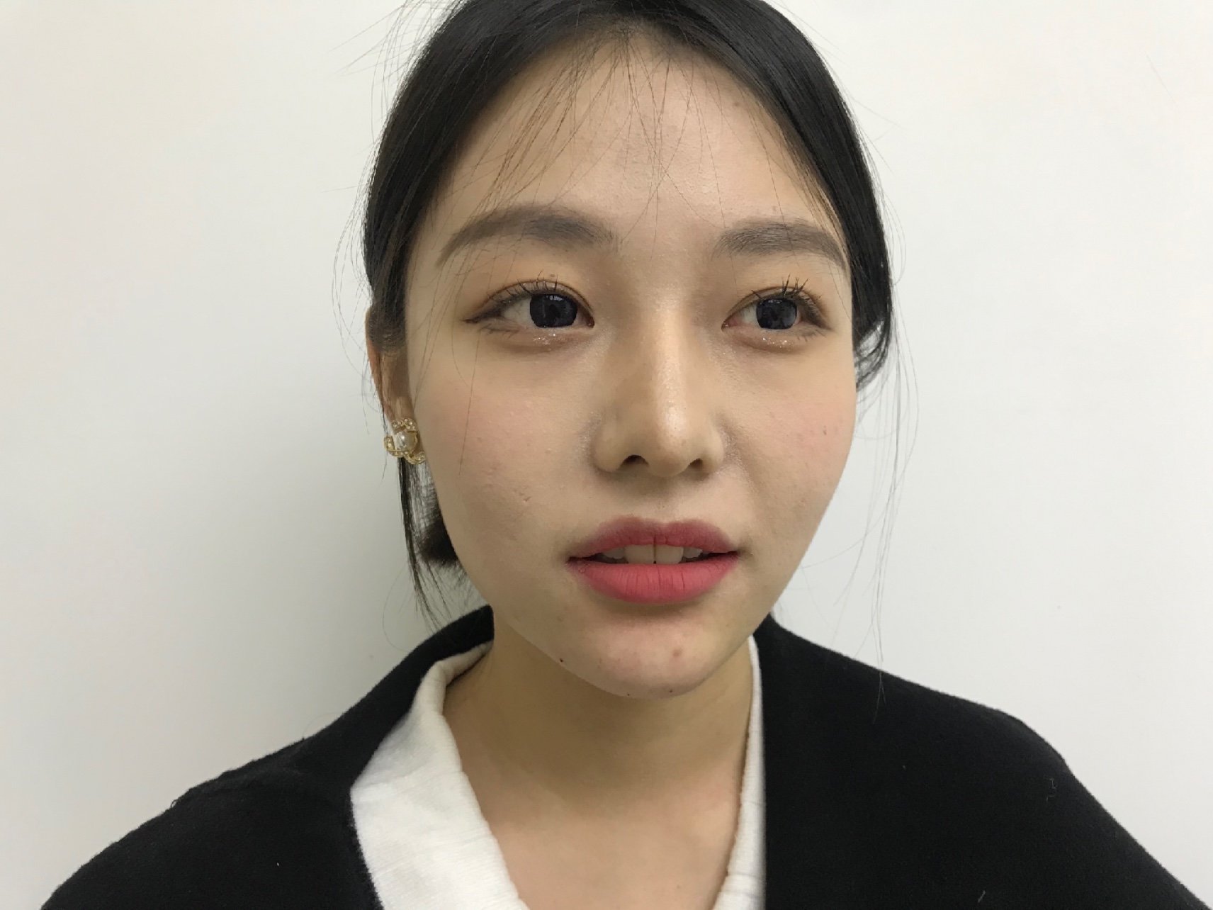 患者下庭短小,下面部比例匆促,轻微后缩,自诉要精致_圈子-新氧美容