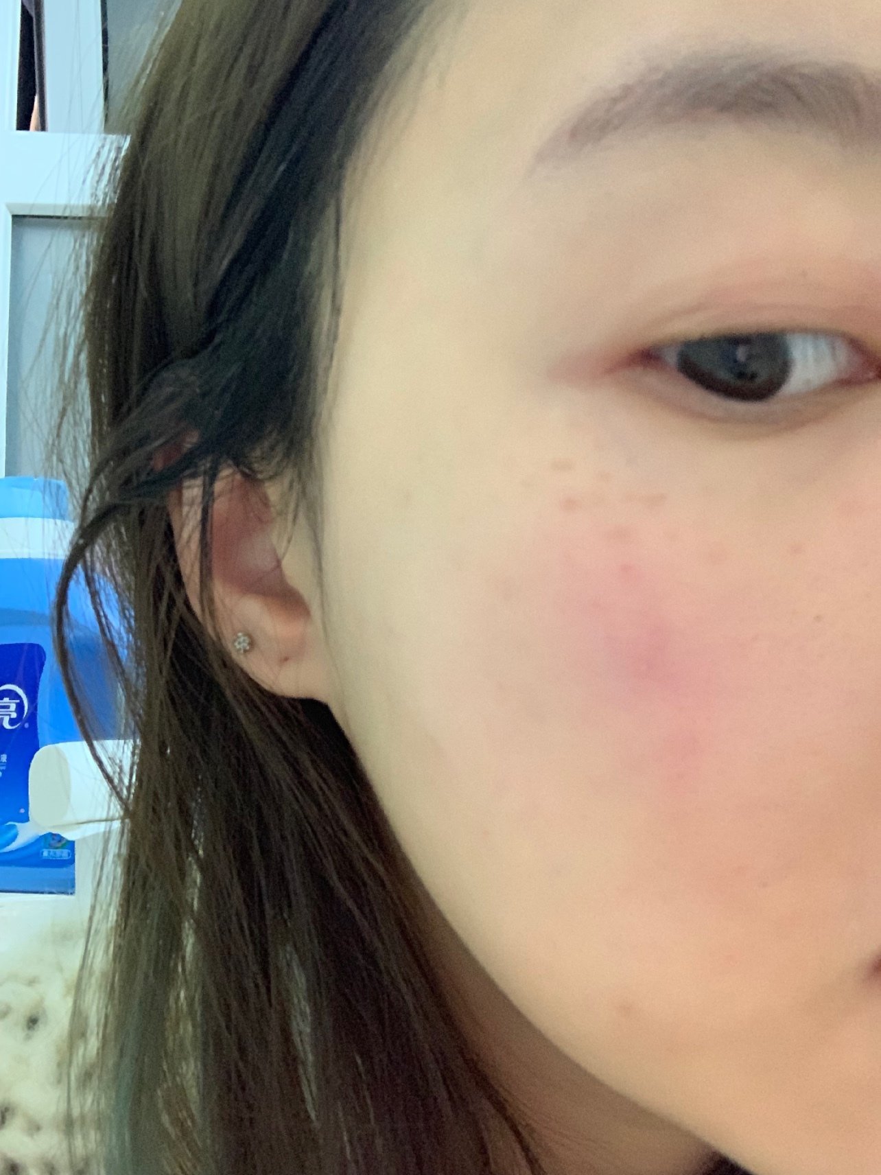 整个感觉脸还是肿的,有些地方还是压会有点疼,他们