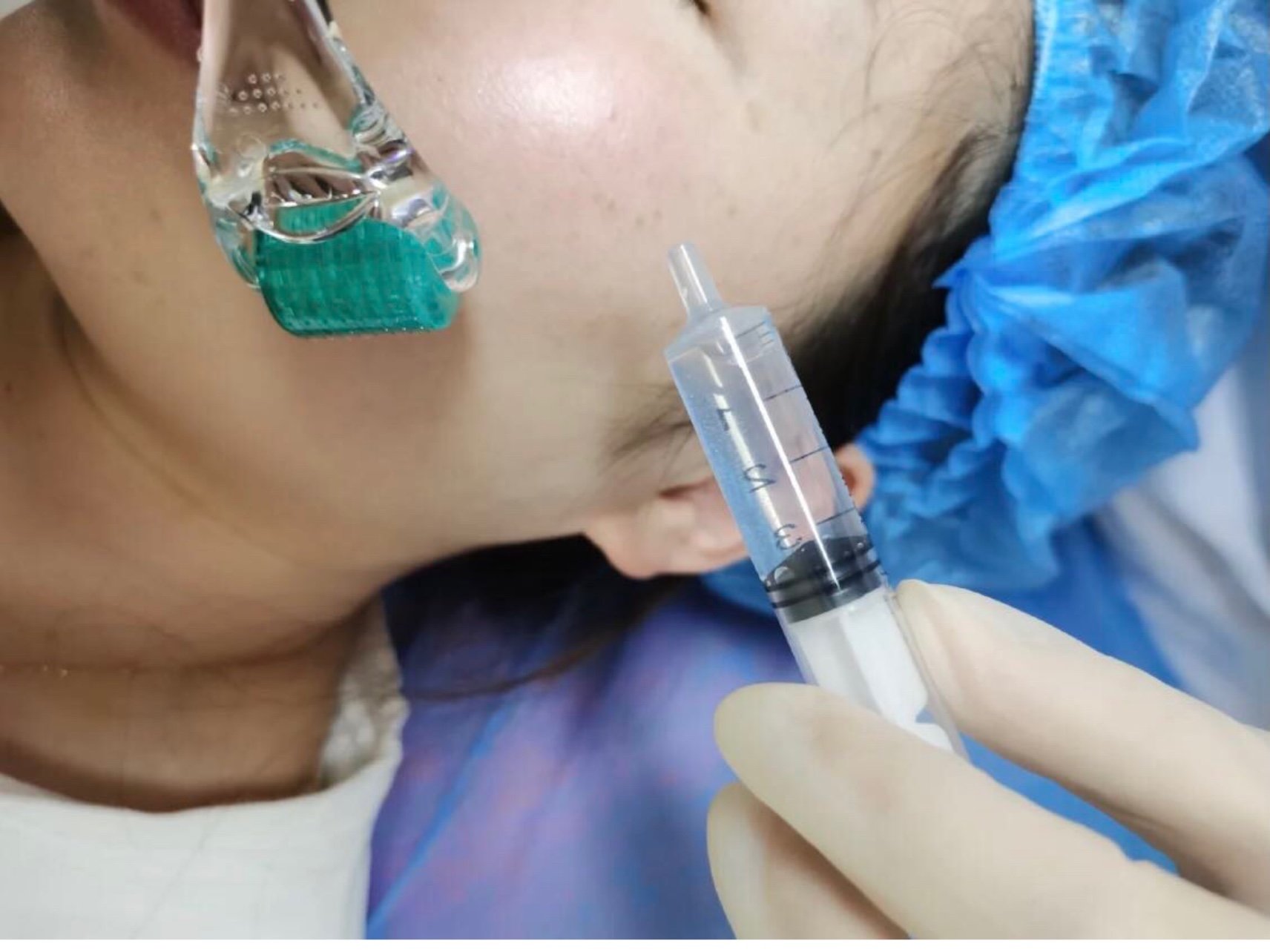 拿滚针在脸上滚的,有个套盒,看了是正品,做完脸有点_圈子-新氧美容