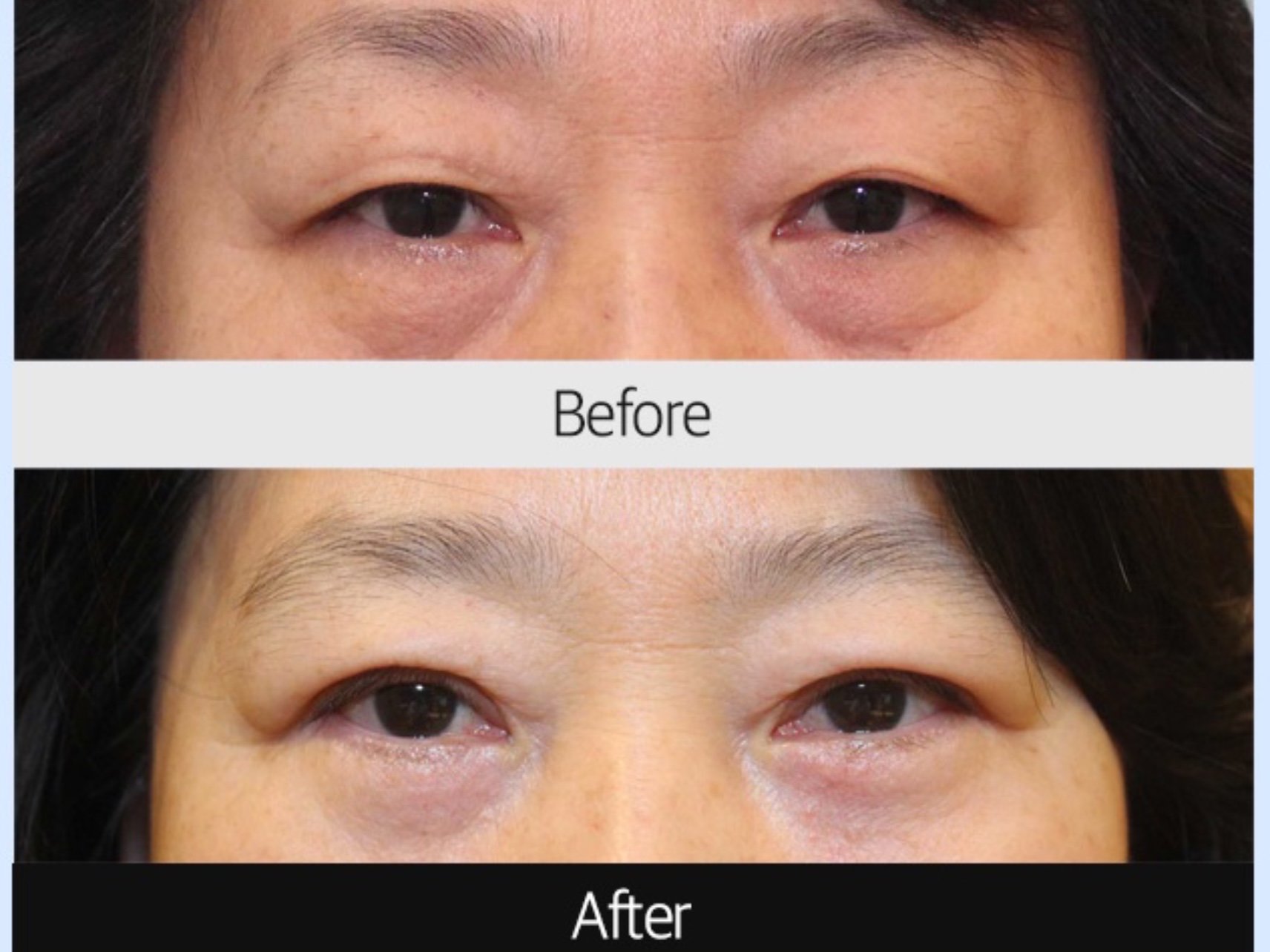 首页 此页面仅支持预览 Avatar 陈雪糕hhh 124篇日记 老年眼睑整形的主要项目有哪些 一 眼睑松弛 随着机体的老化 眼周的老化也越来越明显 眼部皮肤肌肉松弛 三角眼 眉下垂 皱褶增多 眼窝凹陷 通过手术祛除适当的皮肤 肌肉 脂肪 美目翘睫或者提眉术