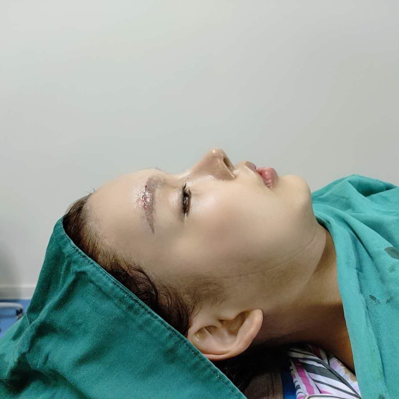 膨体眉弓修复第1天