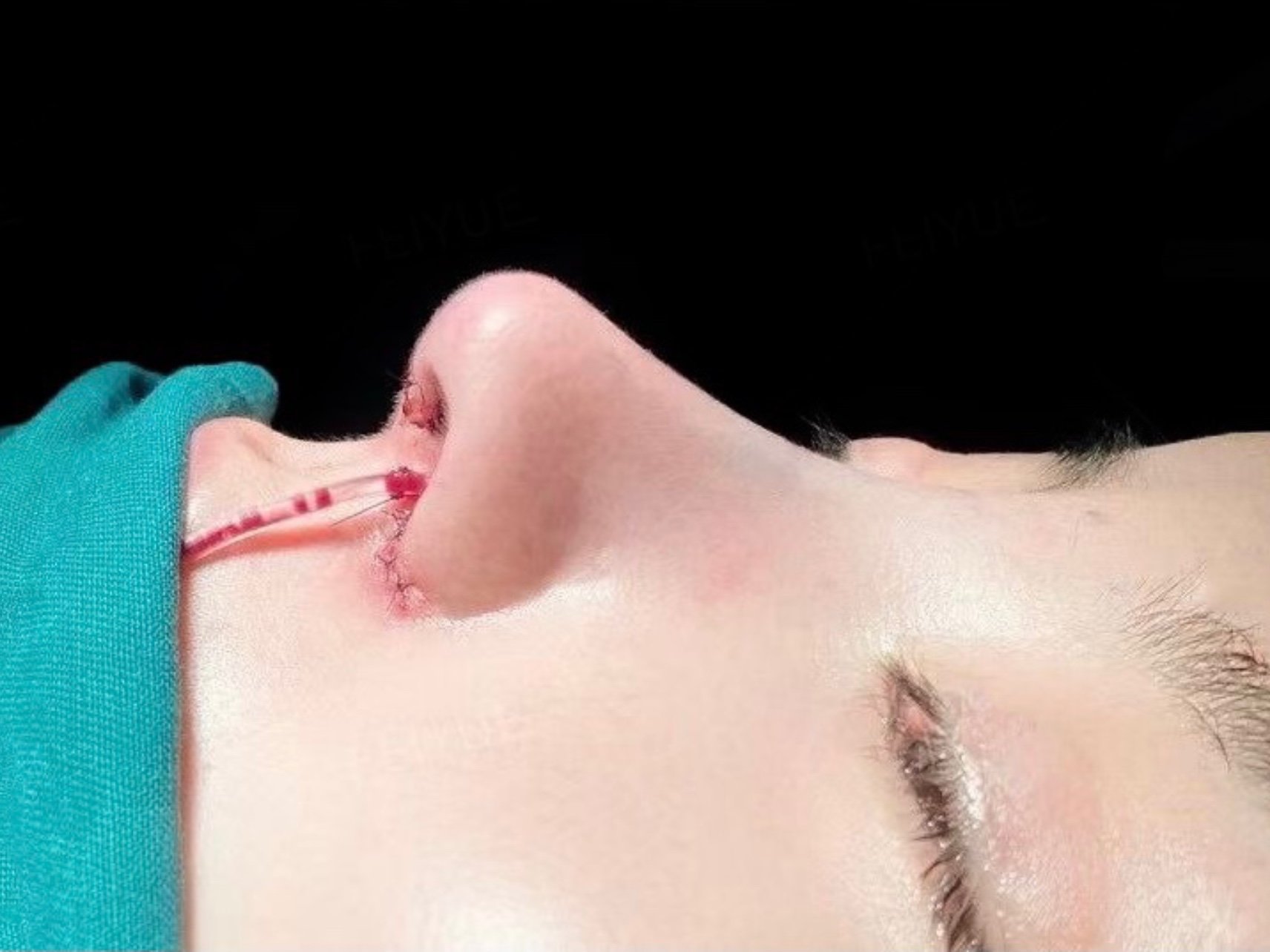 双侧耳软骨隆鼻案例分享整形医生案例大赏