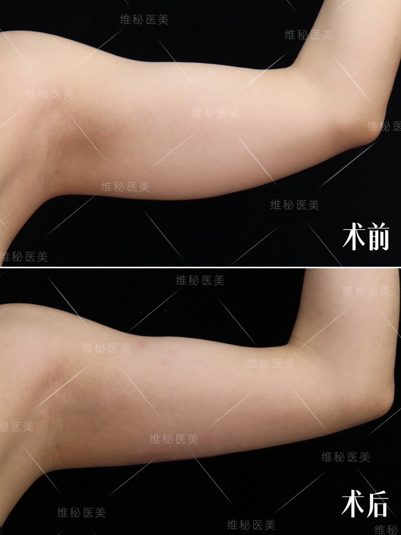 这位求美者术前手臂脂肪堆积肥厚,属于传统所说的"蝴_圈子-新氧美容