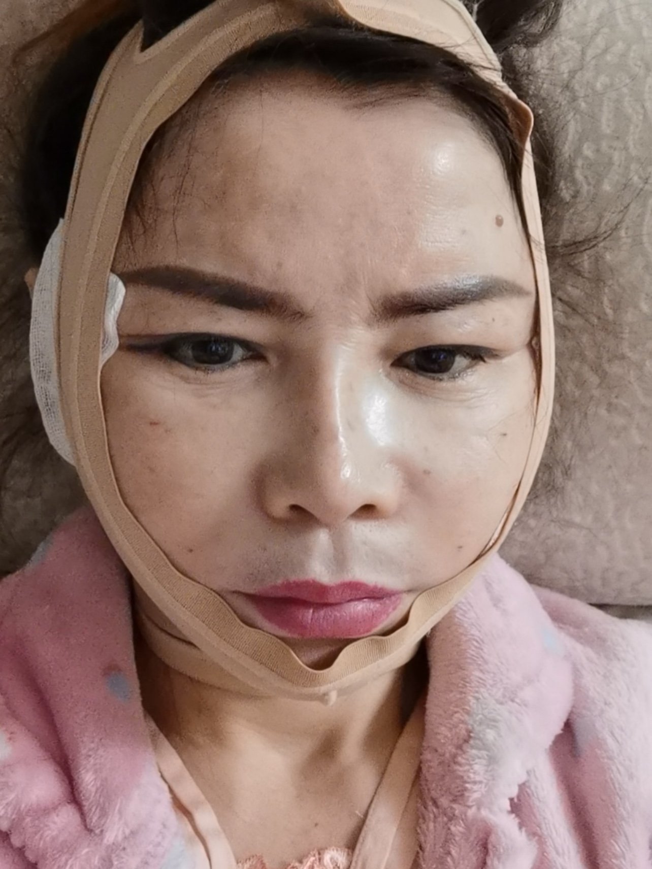 今天是中下面部拉皮后的第三天,是肿胀期,绷带是为了_圈子-新氧美容