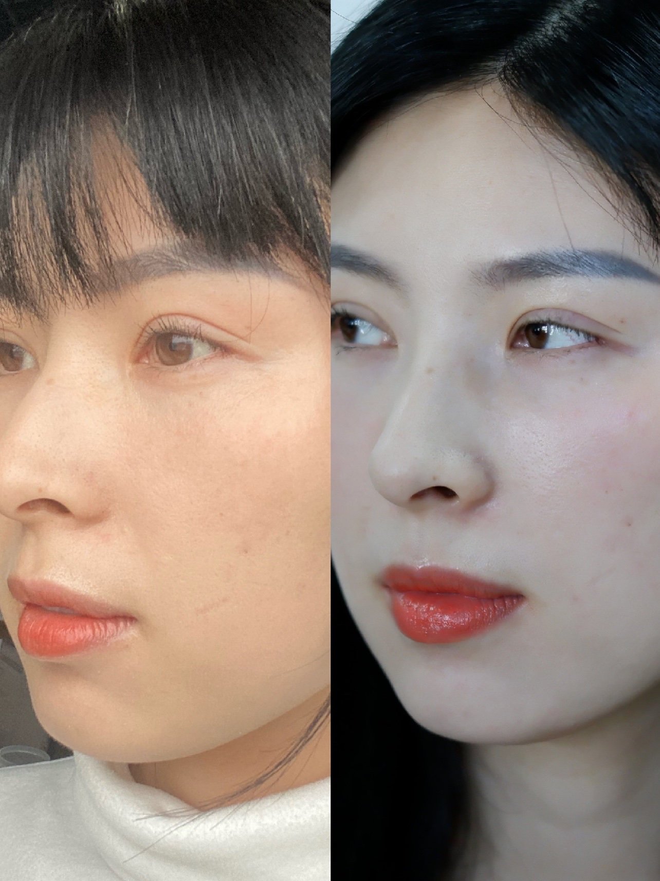 婕尔玻尿酸填充苹果肌77鼻基底91注射玻尿酸第8天啦99_圈子