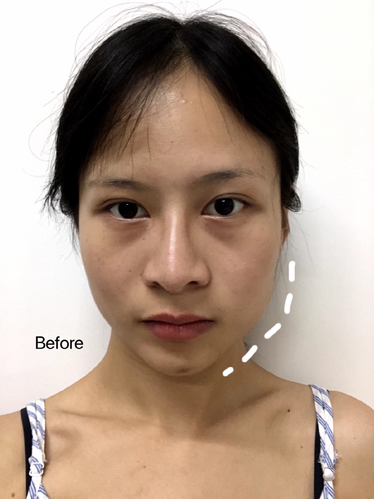 下颌角突出,咬肌也是比较大的,脸部线条不够流畅