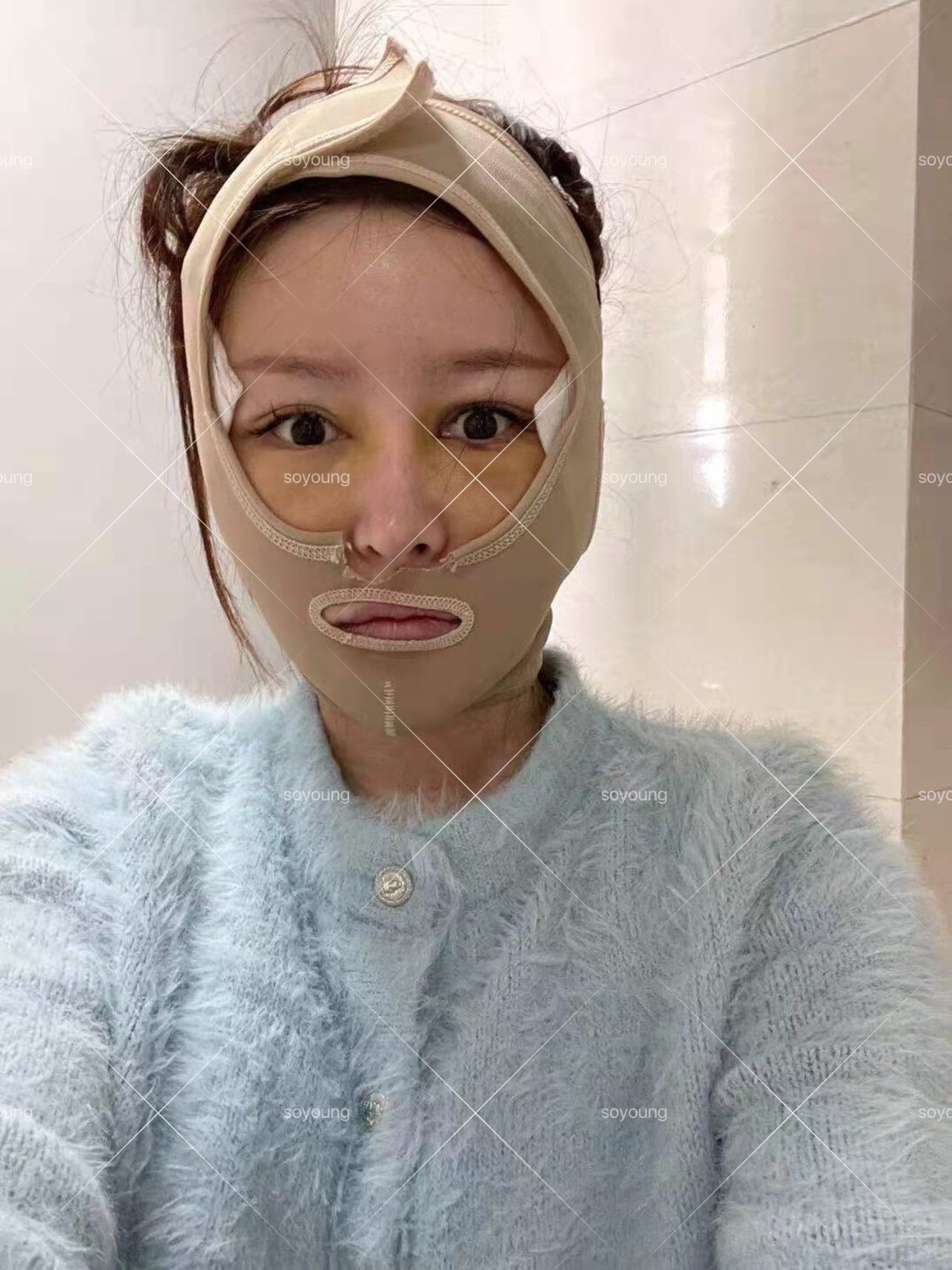 微拉美的创伤蛮大的,但是出来的效果能管好几年,_圈子-新氧美容整形