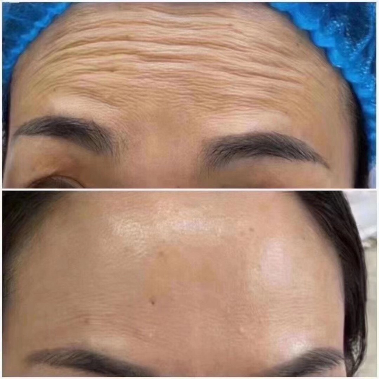 额头打完除皱针一个多月了效果杠杠滴