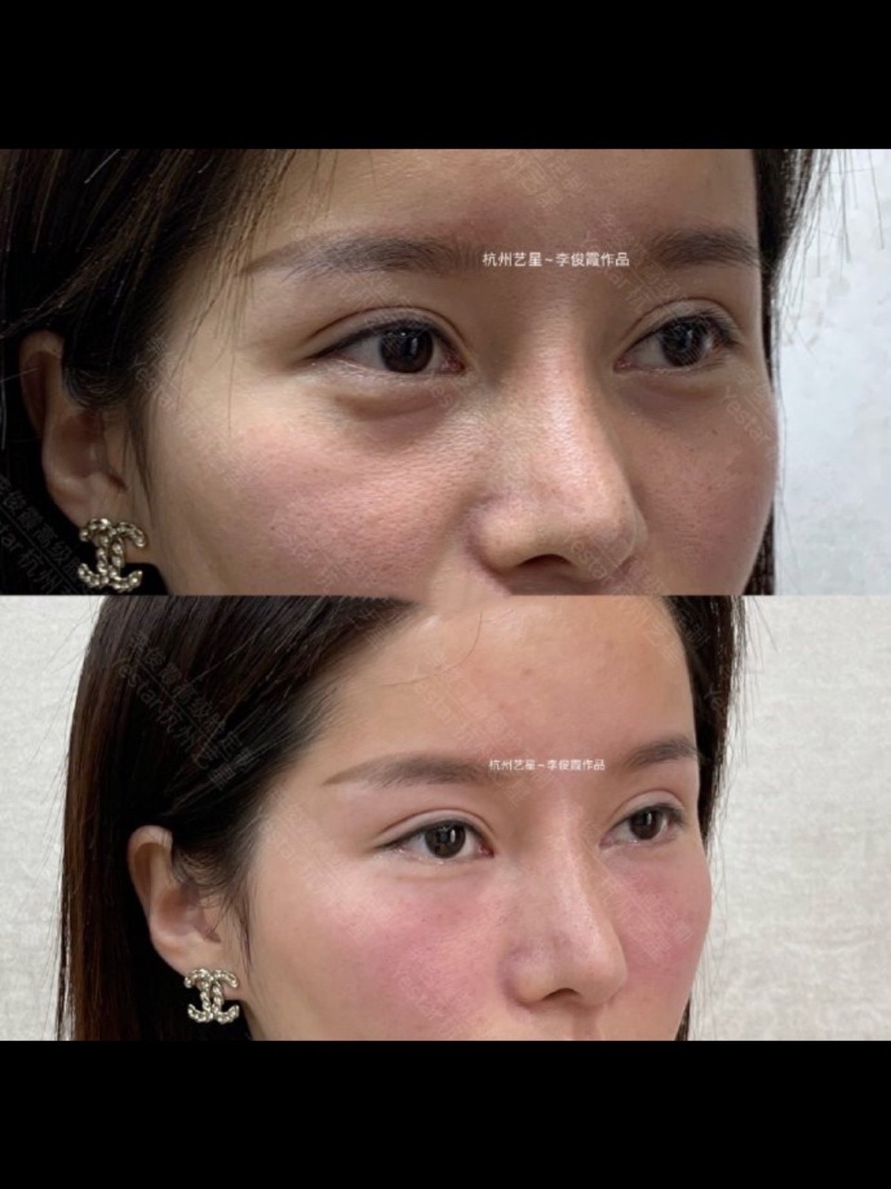11泪沟案例分享术前泪沟严重,述求填充泪_圈子-新氧美容整形