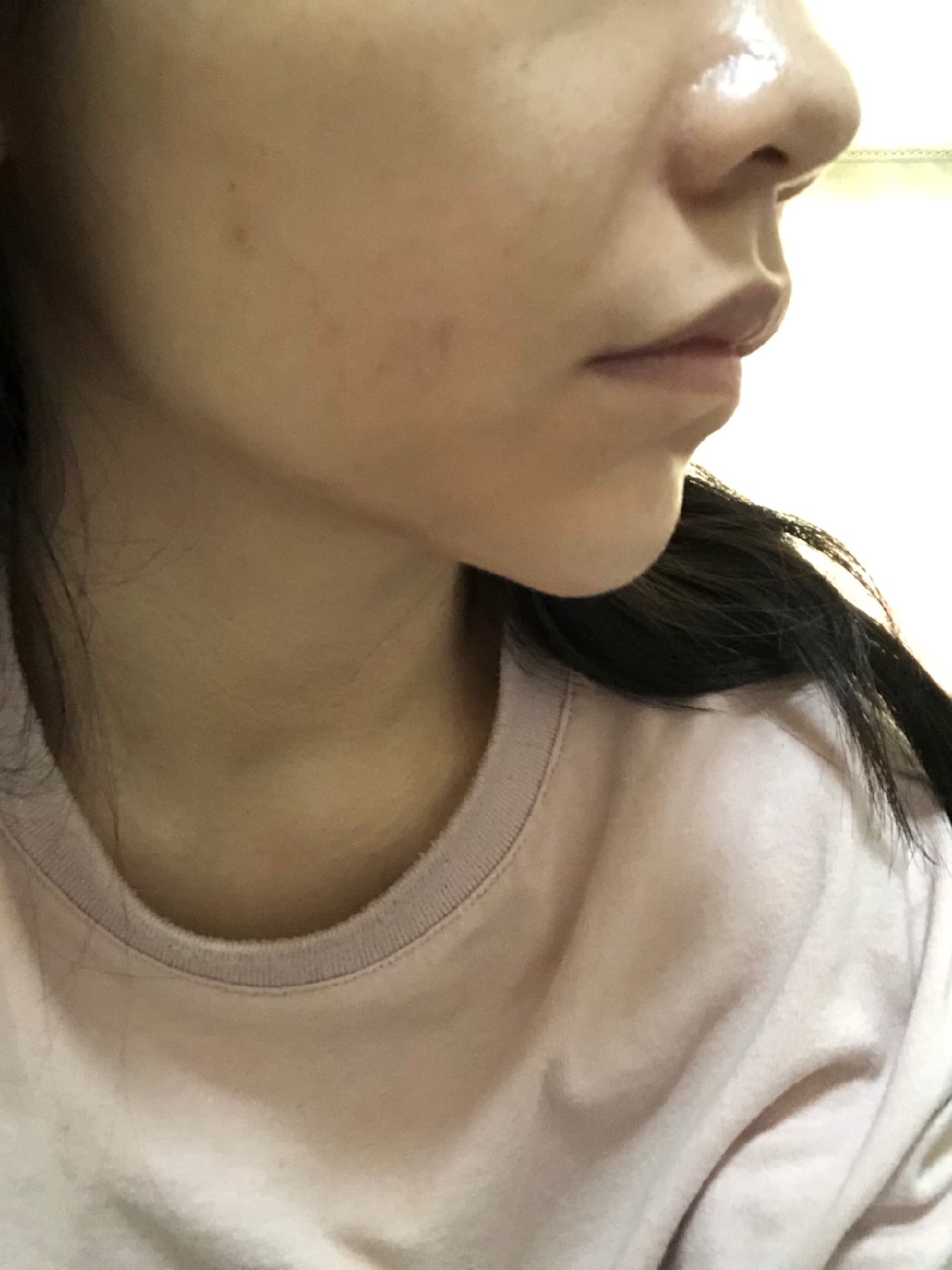 新氧体验官婕儿玻尿酸填充法令纹一周反馈