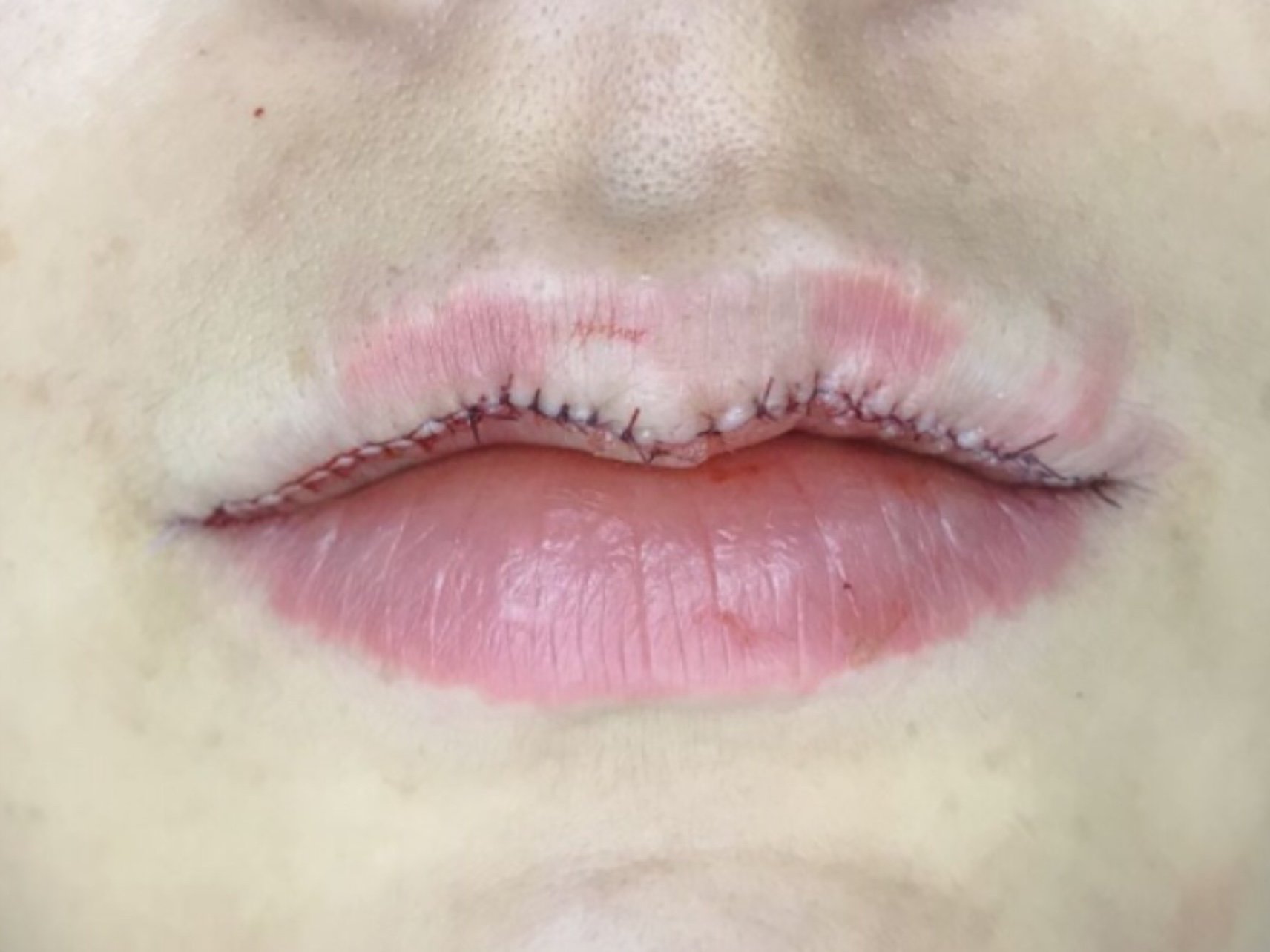 一开始还担心有疤,后来才知道,嘴巴上一般不容易留