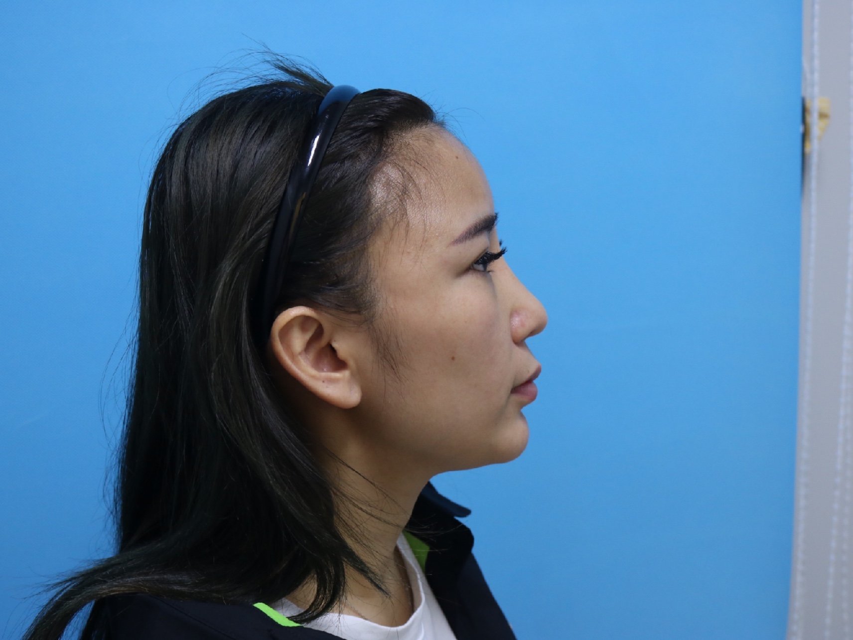 记我的异体骨鼻部多项,半年前其实有在广东那边做过隆鼻_圈子-新氧